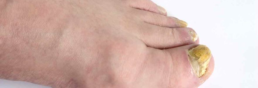 Nagelpilzinfektionen